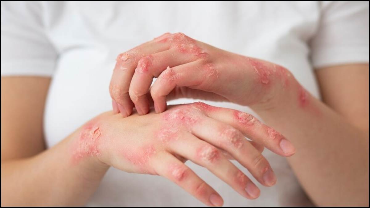 29 01 2023 leprosy 23312748